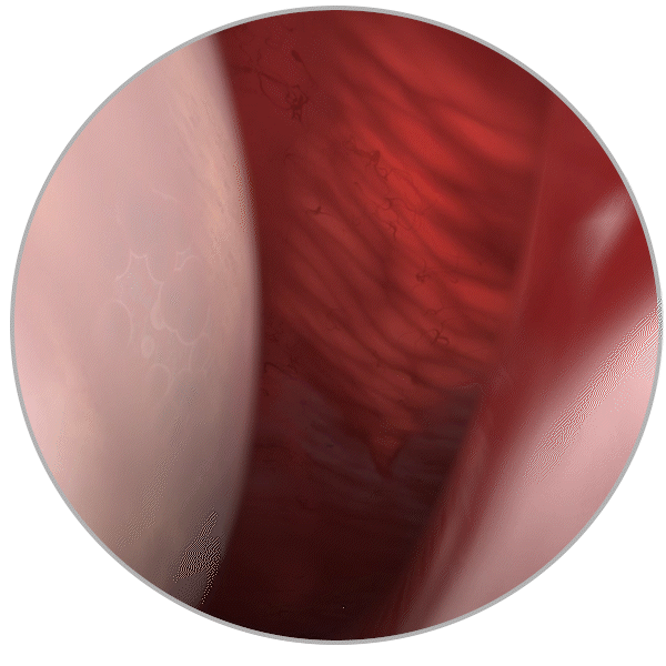 blunt sweeping motion