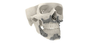 Titanium Orthog Mandibular Max image