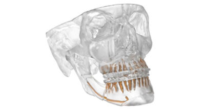 Model skull with splints