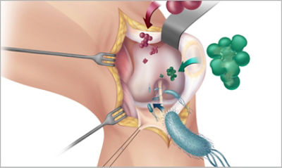 SSIs congregating on a surgical site not using 2% CHG cloths