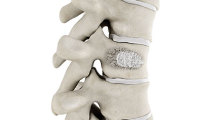 2000_Vertebroplasty