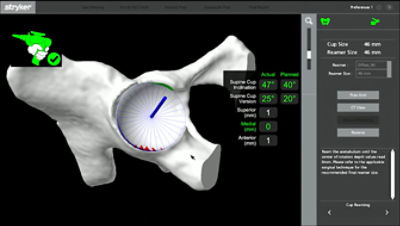 Guided reaming on Mako screen 