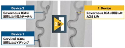 AXS Lift simple setup