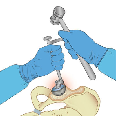 Revision hip replacement surgery