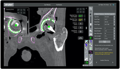 Acetabular cup planning