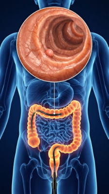 Colonoscopy procedure showing a polyp in the large intestine