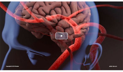 Animation Mechanical Thrombectomy image