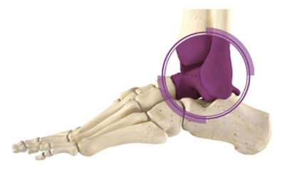 Total Ankle Replacement