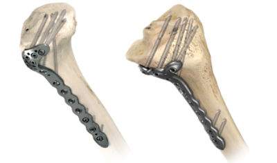 AxSOS 3 Ti Proximal Tibia