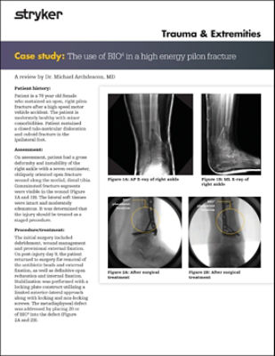 BIO4: High energy pilon fractures