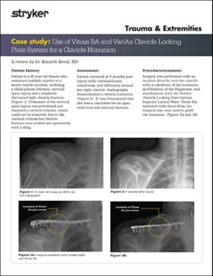 Vitoss BA: Clavicle Fracture w/ VariAx Clavicle Locking Plate System
