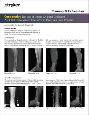 Vitoss BA: Pilon Fracture w/ AxSOS 3 Distal Anterolateral Tibia Plate