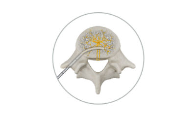 OptaBlate BVN system enables smooth cannula entry and controlled curve for precise targeting