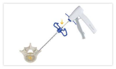 Step 2: Insert introducer with conduit until black distal line reaches the cannula; squeeze gray introducer lever