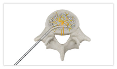 Step 3: Using X-ray and a mallet, advance introducer and conduit across the spinous process