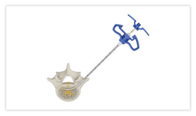 Step 1: Under X-ray, insert access cannula to the posterior vertebral wall and remove stylet