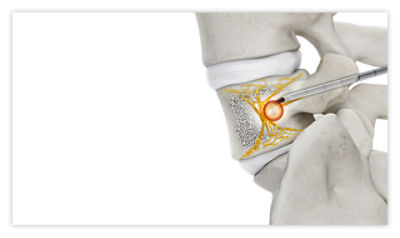Step 6: Unlock tubing clamp to start saline flow, then begin ablation