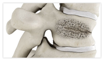 Step 1: Guide needle into fractured vertebra using fluoroscopy