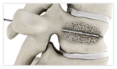 Step 6: Stabilized vertebral body