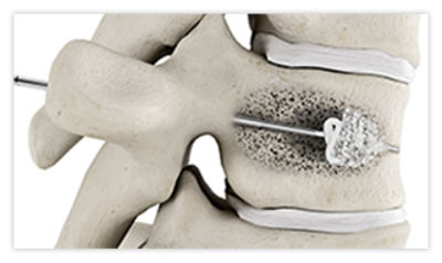 Step 3: Insert balloon catheter into the fractured vertebra