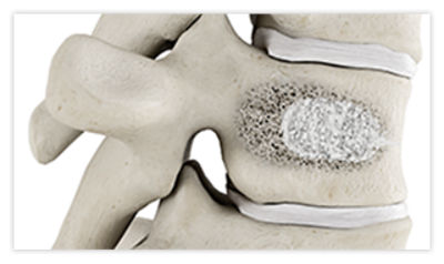 Step 2: Insert hand drill into the anterior third of the vertebral body to create a pathway