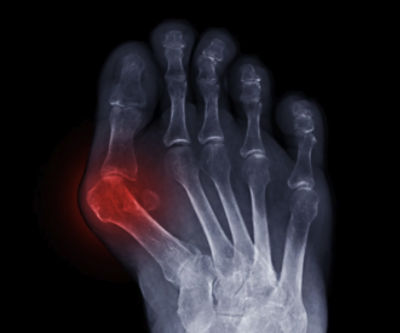 IMAGE - Bunion Solutions