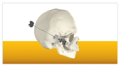Advance MidFace Distractor