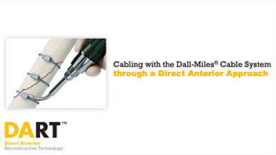 Cabling with the Dall-Miles® Cable System through a Direct Anterior Approach