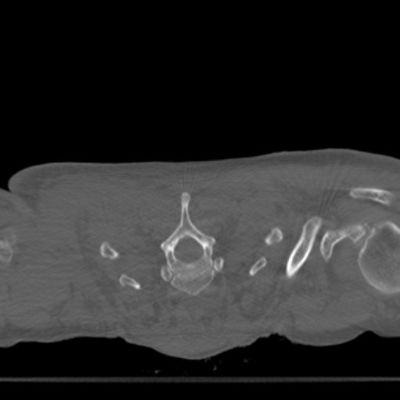 Cervicothoracic_StandardmA_helical_PreOp