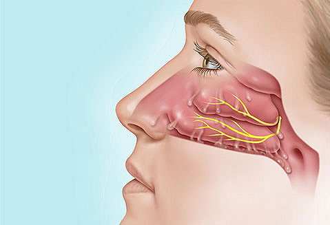 Chronic Rhinitis Nasal Cavity