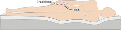 direct superior approach patient positioning image