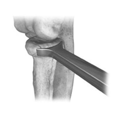 Evolve Triad  in-situ plate sizers