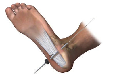 Stryker Foot and Ankle Claw II Plating hero image