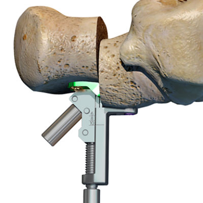 FA-Ortho-3DI-Foot-Recon-Medial-Displacement