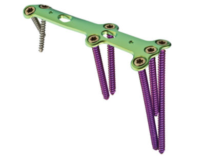 FA-Ortho-3DI-Foot-Recon-Medial-column-plate-02