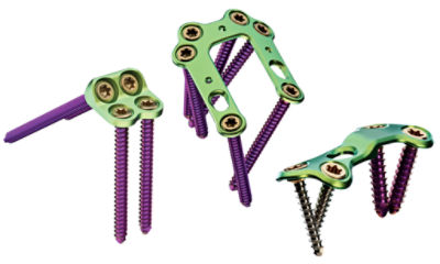 image of Ortholoc 3Di Foot Reconstruction Plating System