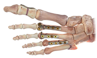 Ortholoc2SmallBones