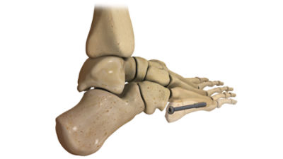 Ortholoc 2 Jones Fracture image