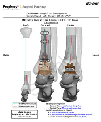Stryker Prophecy Footprint sample report - Total Ankle Replacement Surgery