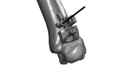 FA-Prophecy-Step5-surgery