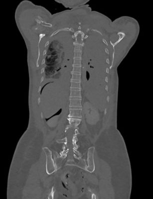 Full Spine Coronal 1