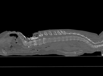 Full Spine Post Op Sagittal