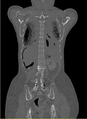 Full Spine Postop (30 standard) Coronal