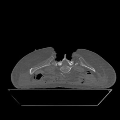 Full Spine postop (30 Standard mA) 45mA helical