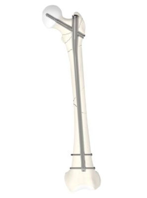 Gamma4-Long-Nail