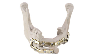 Stryker Mandible Reconstruction Plate on Jaw