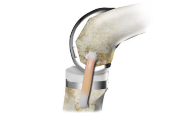 image of Triathlon Primary knee replacement on bone