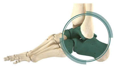 Triple Arthrodesis