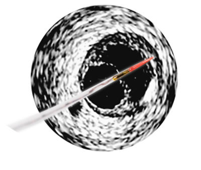 Reprocessed IVUS 