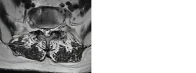 Identifying anatomical landmarks in a mild® patient